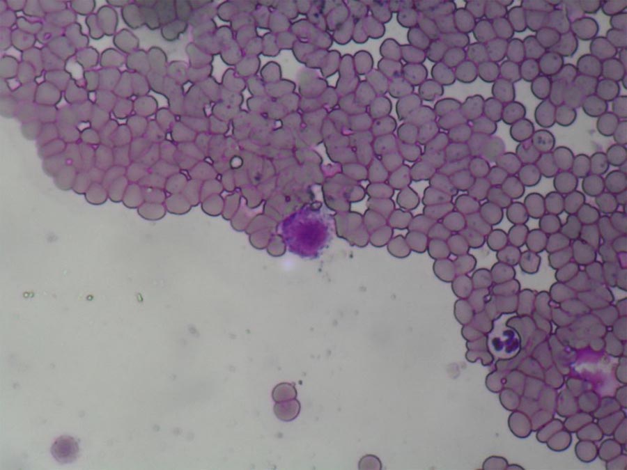 fibrosarcoma